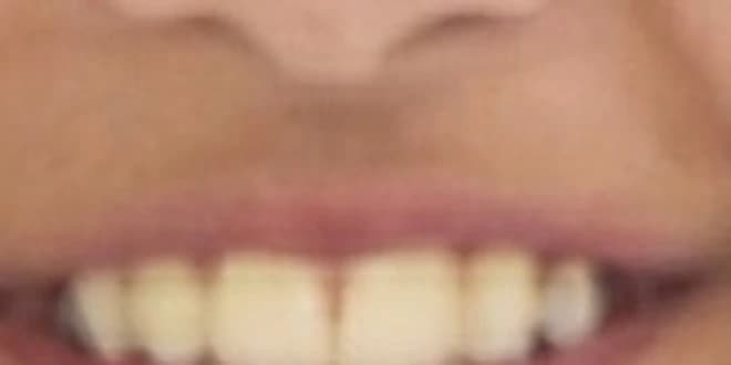 Case 1 after orthodontic treatment