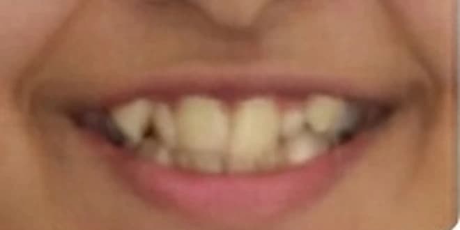 Case 1 before orthodontic treatment