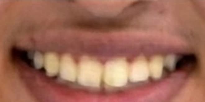Case 2 after orthodontic treatment