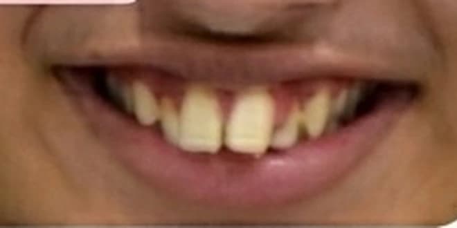 Case 2 before orthodontic treatment