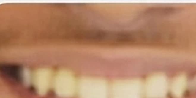 Case 3 after orthodontic treatment