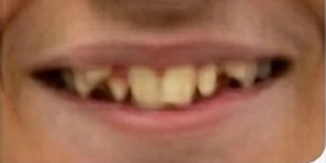 Case 3 before orthodontic treatment